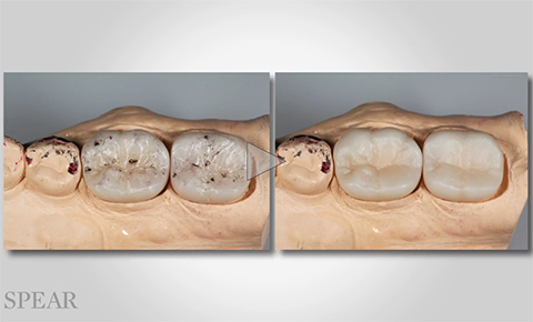 zirconia-restorations-ad