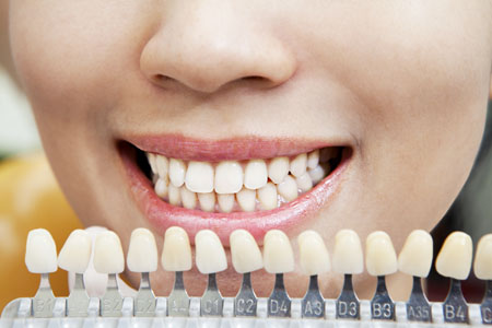 dental-veneers20153